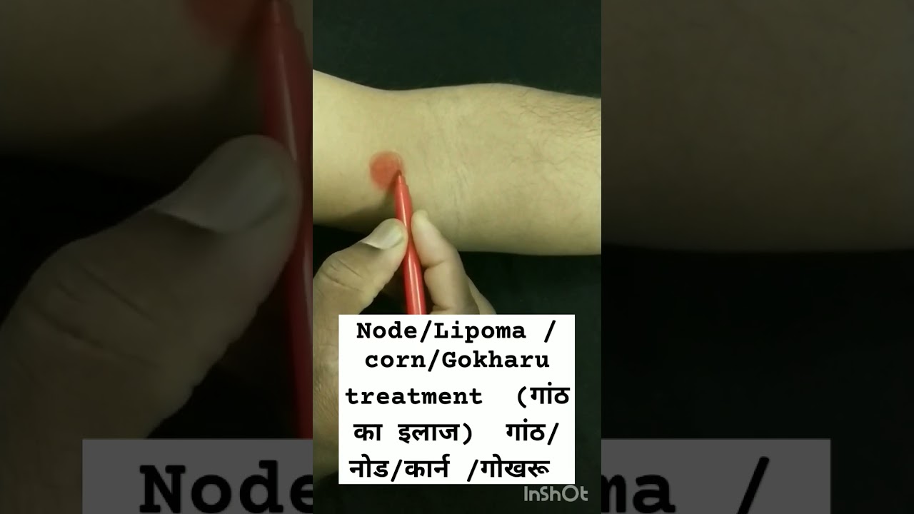 Node/Lipoma/corn/Gokharu treatment #nodes #corn #lipomas #cyst #gath #Health #short #trending #viral